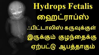 Hydrops Fetalis ஹைட்ராப்ஸ் ஃபிட்டாலிஸ் கருவுக்குள் இருக்கும் குழந்தைக்கு ஏற்பட்டு ஆபத்தாகும் [upl. by Kylila]