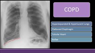 Chest Xray with Black lung field COPD Pneumothorax amp Bullae cxr radiology [upl. by Novahc]