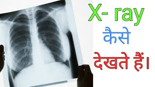 How to read Chest Xray  Hindi language [upl. by Ahsaeym]