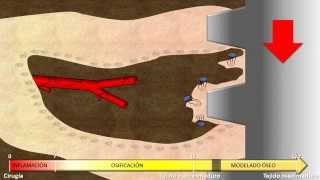 Implantología Oral Biocéntrica Dr Prof Bellotta Resumen OdEspMauricio Haenggi [upl. by Airrej]