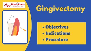 Gingivectomy l treatment of gingival overgrowth and gummy smile l Mediklaas [upl. by Waddington38]