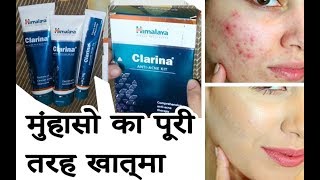 Himalaya Clarina ANTI ACNE KIT Review  Hindi  हिंदी [upl. by Leiand]