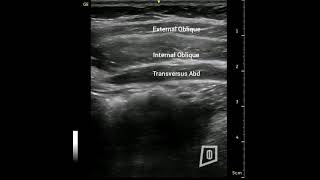 Rehabilitative Ultrasound Imaging of the Transversus Abdominis [upl. by Intosh980]