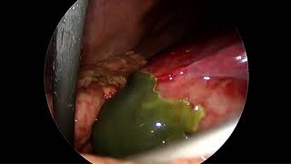 Laparoscopic Cholecystectomy in Gangrenous Gall Bladder [upl. by Goeselt]