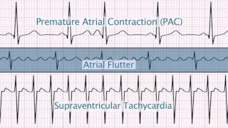 quotSupraventricular Arrhythmiasquot by Christine LaGrasta MS RN CPNP PCAC for OPENPediatrics [upl. by Otreblig]