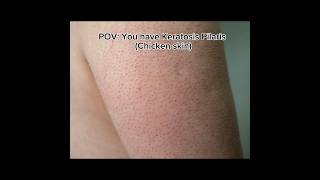 POVYou have keratosis Pilarischicken skinshortskeratosispilarischickenskinstrawberryskin [upl. by Molly969]