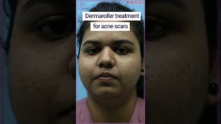 Acne scar treatment  Dermaroller for acne scars  acnescars shorts youtubeshort acne skincare [upl. by Dareg]