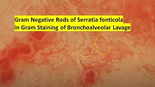 Gram Negative Rods of Serratia fonticola in Gram Staining of Bronchoalveolar Lavage [upl. by Jo-Anne75]