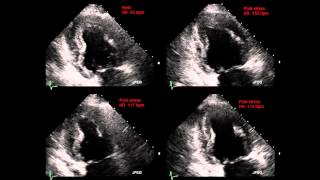 EHJCI  Coronary steal phenomenon from a coronary artery to left ventricular fistula [upl. by Ennaus952]