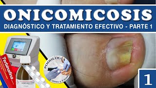 PARTE 1  ONICOMICOSIS  Diagnóstico y Tratamiento Efectivo  Podología Casos y Cosas [upl. by Epoillac]