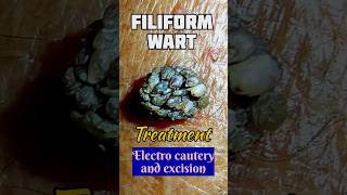 Filiform wart removal 😲 shorts shortsfeed viral doctorskin [upl. by Locklin]