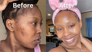 How I Cleared My Acne  Dark Spots  Hyperpigmentation for good in 1 month NO ACCUTANE VIDEO PROOF [upl. by Ennadroj]