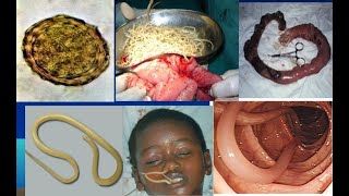 Ascaris Lumbricoides Ascariasis Morphology  Life cycle  Pathogesis  Treatment  Parasitology [upl. by Sirahs]