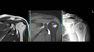 Intraosseus lipoma humeral head [upl. by Yehc]