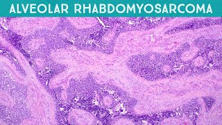 Alveolar rhabdomyosarcoma explained in 5 minutes pediatric pathology USMLE rare disease [upl. by Benedix]