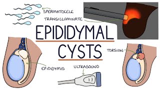 Understanding Epididymal Cysts [upl. by Rutra671]