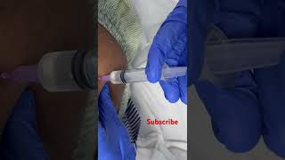 INTRAMUSCULAR INJECTION IM PROCEDURE shorts [upl. by Cianca]