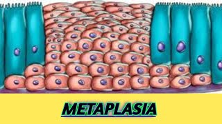 Metaplasia mechanism and examples  Dysplasia aplasia hypoplasia [upl. by Roy721]