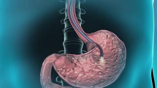 Learn about gastroscopy [upl. by Atcele328]