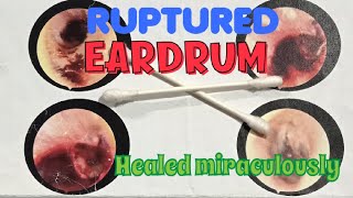 I ruptured my EARDRUM Healed in 6 months without any surgery Heres the story [upl. by Inahteb]