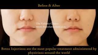 Botox Injection Treatment for Masseter Hypertrophy  Jawline Reduction Treatment  Dr Debraj Shome [upl. by Hpsoj]