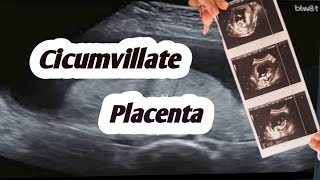 Circumvallate placenta on ultrasoundplacental abnormalities [upl. by Dnomayd563]