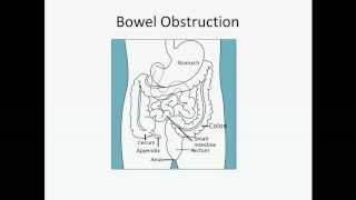 Bowel Obstruction  USMLE Step 2 Review [upl. by Brucie]