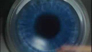 LasikPlus Intralase® Bladeless LASIK Procedure AllLaser Lasik [upl. by Akenor]