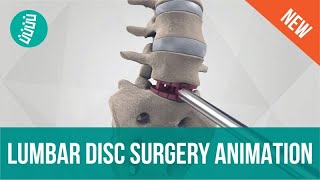 Lumbar Disc Replacement with 3rdGen Technology [upl. by Vihs]