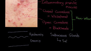 Acne Vulgaris Part 1 [upl. by Quintin]