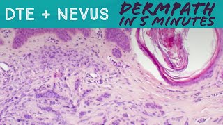 Desmoplastic Trichoepithelioma plus Nevus Dermpath in 5 Minutes dermatology pathology adnexal [upl. by Nylhtiak]