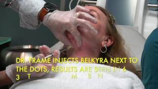 Watch Real Belkyra Injections for Reducing Double Chin Fat [upl. by Halland938]