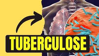 TUBERCULOSE  DEFINIÇÃO AGENTE ETIOLÓGICO MODO DE TRANSMISSÃO PARTE 1 [upl. by Aisinut]