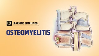 Bone Infection  Causes Risk Factors amp Treatment with Animation [upl. by Blight121]