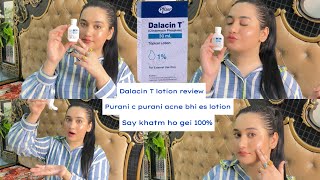 Dalacin T Lotion Review Bye bye Acne 😡 say Hi to new skin❤️Best Acne lotion 100 guaranteed results [upl. by Arvid]