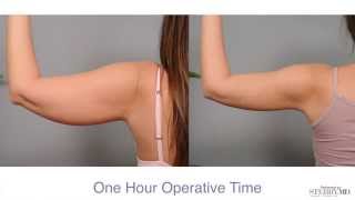 Get Firm Sculpted Arms With Smartlipo™  Dr Sterry Explains [upl. by Abrahams]