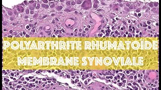 POLYARTHRITE RHUMATOÏDE  MEMBRANE SYNOVIALE  PATHOLOGIE [upl. by Digdirb471]