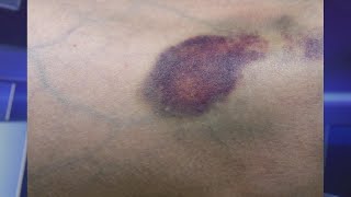 Do You Bruise Easily Learn How to Prevent and Fade Them [upl. by Etka]