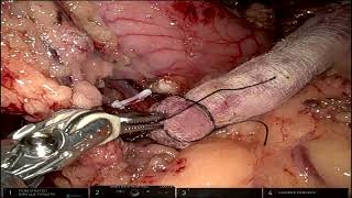 Robotic Harvesting of Pedicled Omental Flap [upl. by Nnayar]