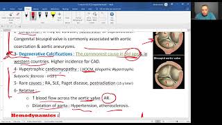 Aortic stenosis 2025 [upl. by Ahsilef]