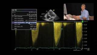 LowFlow Aortic Stenosis [upl. by Ellehcer482]