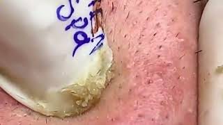 Blackheads Removal  Acne Treatment And Beauty Love blackheads [upl. by Lyrehc418]