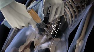 Arrow ® OnControl® Bone Marrow Biopsy [upl. by Minni]