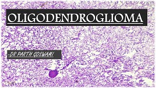 Oligodendroglioma [upl. by Ernesto]