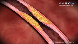 STENT INIMA  DR PRETORIAN  REGINA MARIA PONDERAS ACADEMIC HOSPITAL  TEL 021 9886 [upl. by Artemisa]