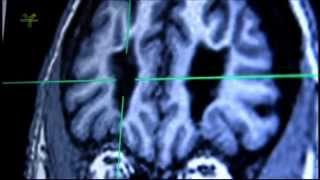 Transorbit lobotomy and MRI examination of living lobotomized patients brain [upl. by Kcirde]