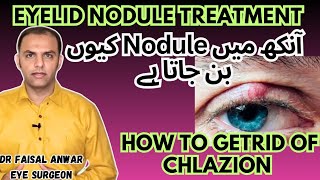 Chlazion  Treatment  Causes and Diagnosis Chlazion Removal drfaisalanwar eyelidnodule Chlazion [upl. by Hbaruas929]