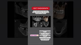 Importance of CBCT Radiographs in dentistry [upl. by Nwahsd18]