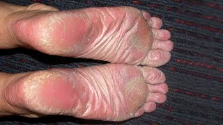 Stepping Towards Relief Effective Ways to Treat Psoriasis on Your Feet [upl. by Saimon]