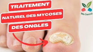 Traitement naturel des mycose  mycose pied  mycose ongle pied  mycose ongle main et les autres [upl. by Goodspeed]